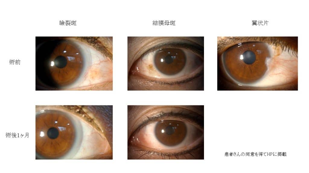 眼科 結膜 白目 のしみ ほくろ 瞼裂斑 結膜母斑 への対処 ラッフルズジャーパニーズクリニック